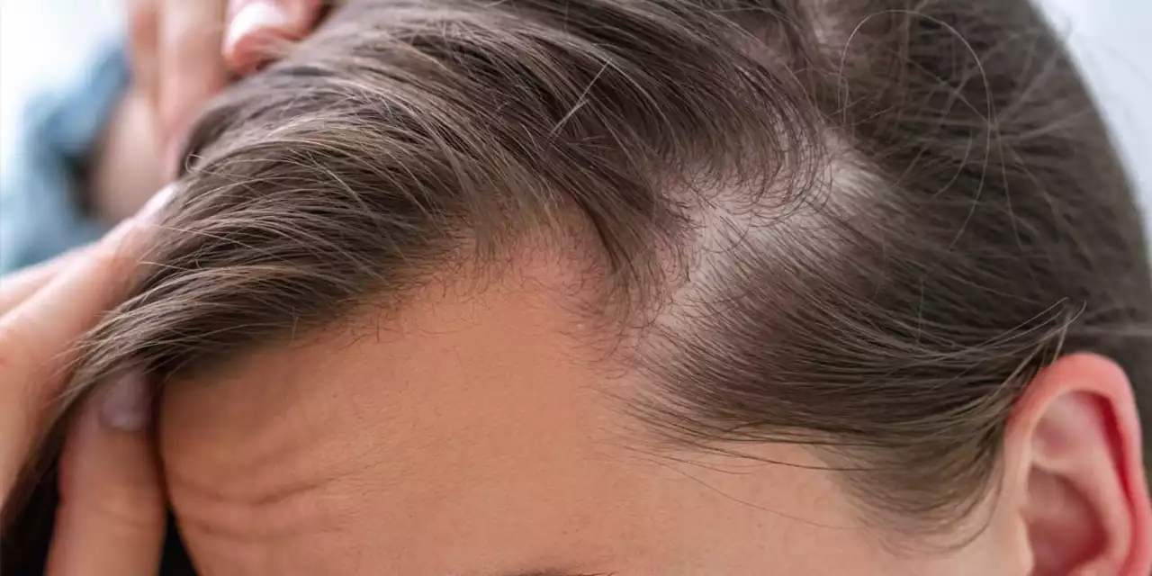Cómo identificar los primeros signos de la alopecia androgénica